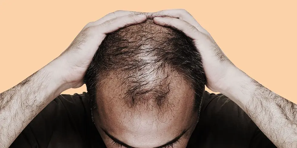 بهترین مکمل برای ریزش مو شدید