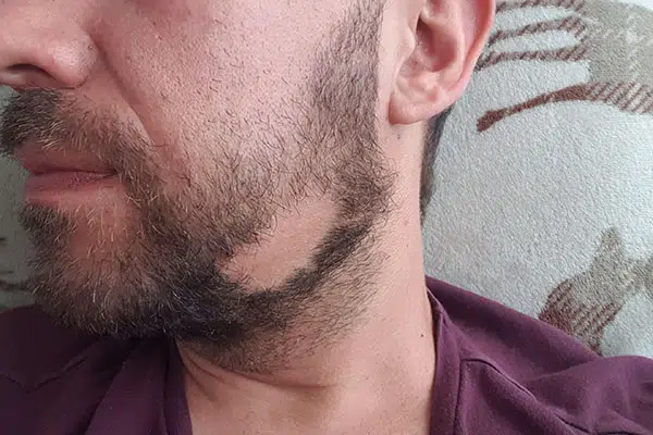 ریزش مو سکه‌ای ریش