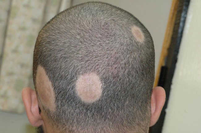 ریزش مو سکه‌ای