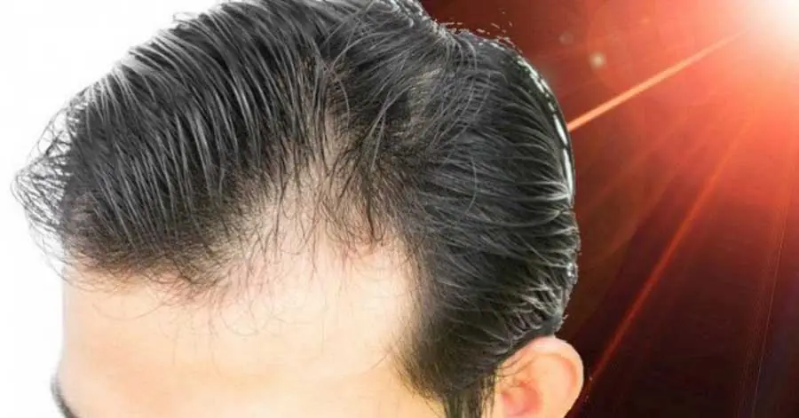 درمان ریزش شدید مو در نوجوانی