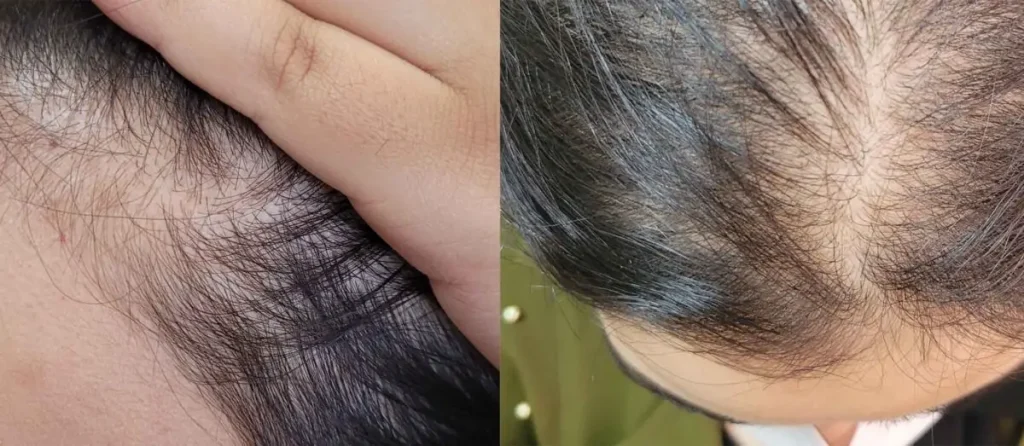 ریزش موی آندروژنتیک (Androgenetic Alopecia)