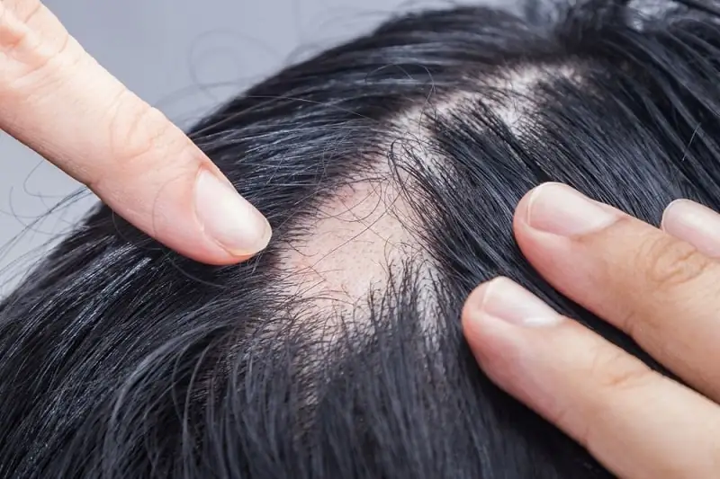 ریزش موی سکه‌ای (Alopecia Areata)