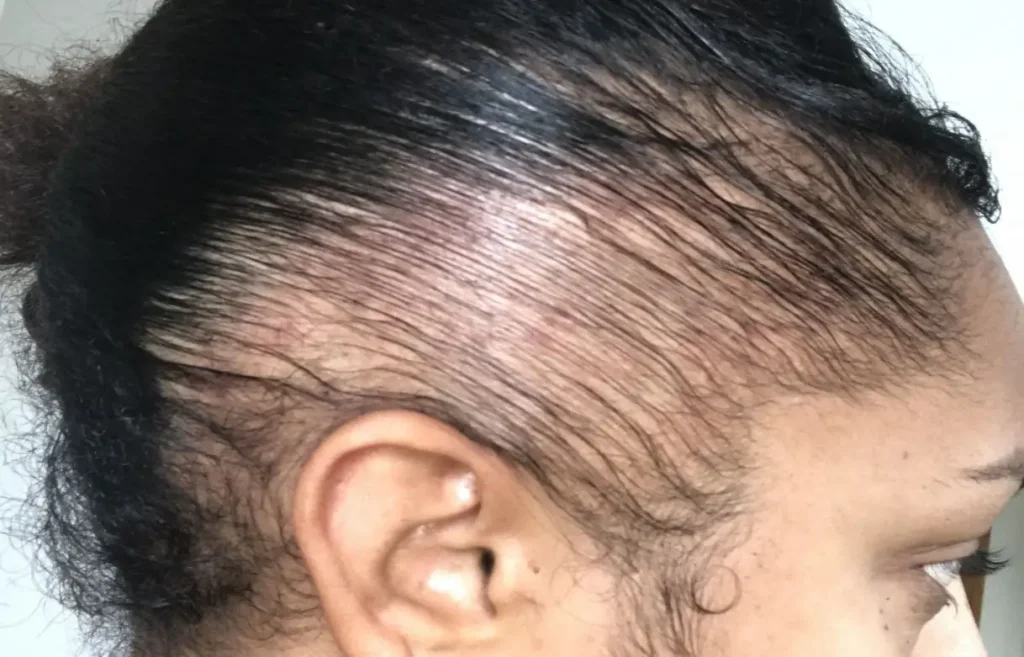 ریزش موی کششی (Traction Alopecia)