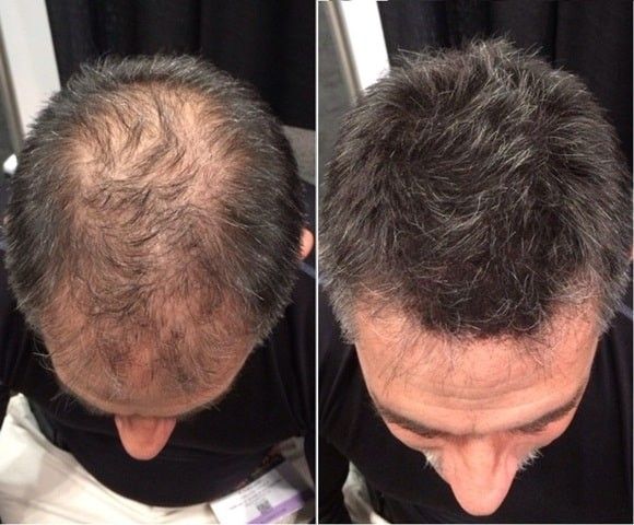 برای جلوگیری از ریزش مو و تقویت مو چه باید کرد