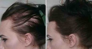 علت ریزش مو در زنان بالای ۴۰ سال