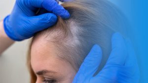 علت ریزش موهای کاشته شده بعد از یک سال یا چند سال