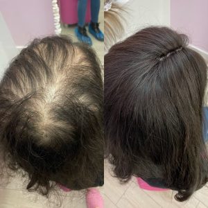 برای جلوگیری از ریزش مو و تقویت مو چه باید کرد