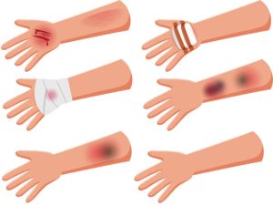 عوارض احتمالی و موارد منع حجامت سر