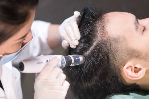 مزوتراپی مو چیست