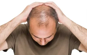 جلوگیری از ریزش مو در دوره استروئیدی
